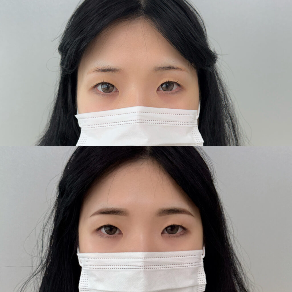 부천눈썹문신 티메스의 전후 비교 컷