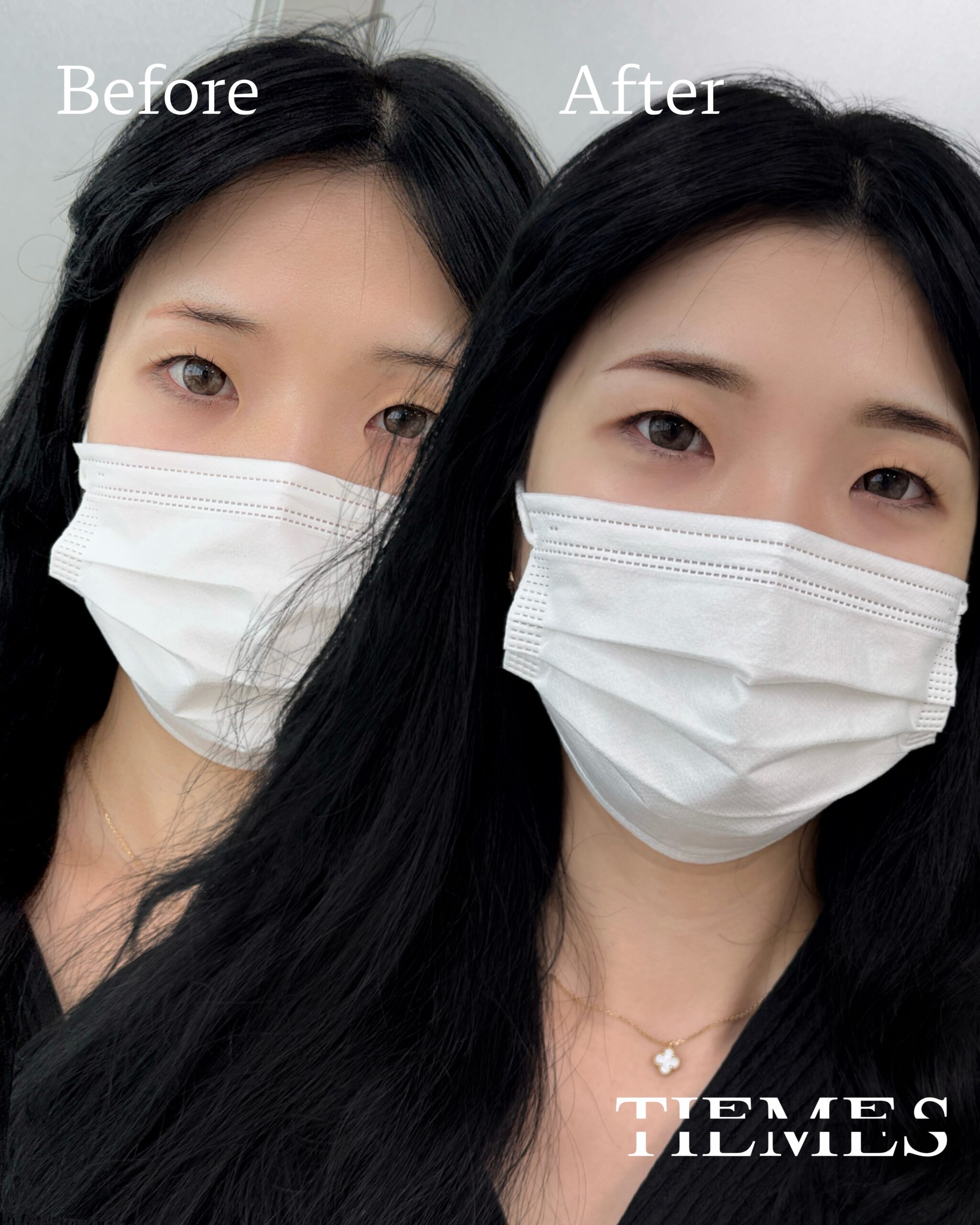 삼삼동눈썹문신 잔흔 커버 전 후 비교 컷